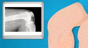Operación de la rodilla